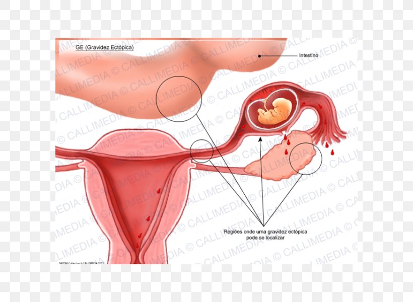 Ectopic Pregnancy Uterus Gynaecology Symptom, PNG, 600x600px, Watercolor, Cartoon, Flower, Frame, Heart Download Free