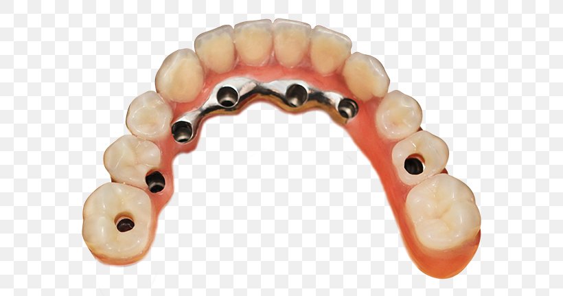 Tooth Dentures Crown Bridge Implantology, PNG, 600x431px, Tooth, Bridge, Cobaltchrome, Crown, Dental Implant Download Free