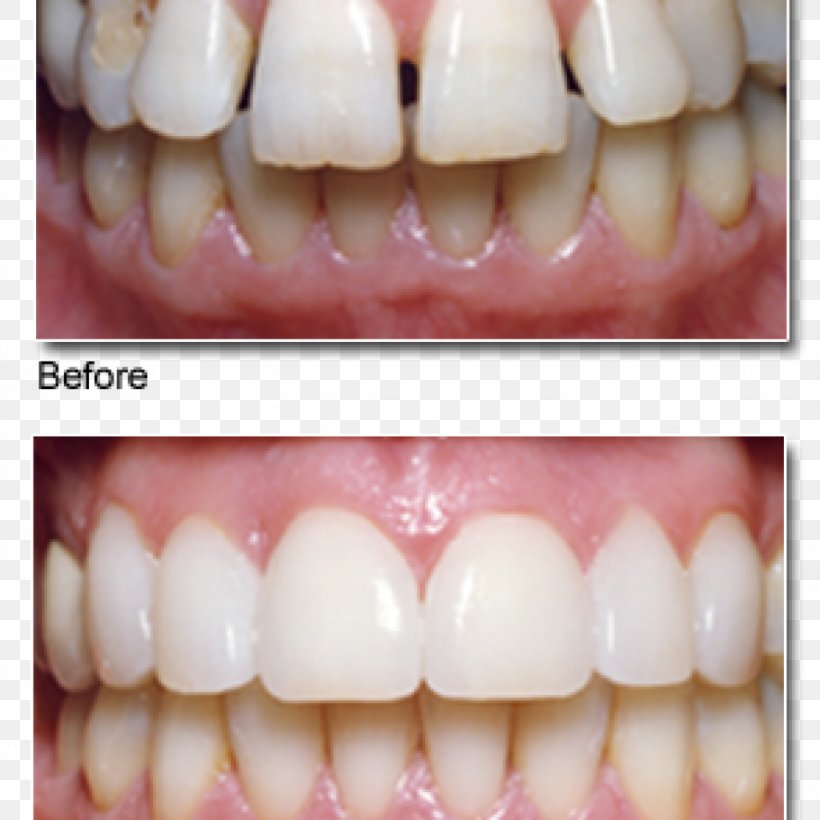 Veneer Cosmetic Dentistry Chris Johns, DDS, PNG, 1024x1024px, Veneer, Cosmetic Dentistry, Dental Implant, Dental Laboratory, Dental Porcelain Download Free