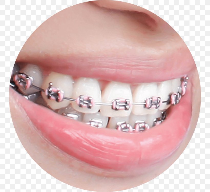 Dental Braces Dentistry Orthodontics Human Tooth, PNG, 750x750px, Dental Braces, Cheek, Chin, Clear Aligners, Color Download Free