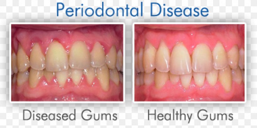 Swollen Gums Gingivitis Periodontal Disease Dentistry, PNG, 863x430px, Gums, Bleeding On Probing, Cosmetic Dentistry, Dental Extraction, Dental Floss Download Free