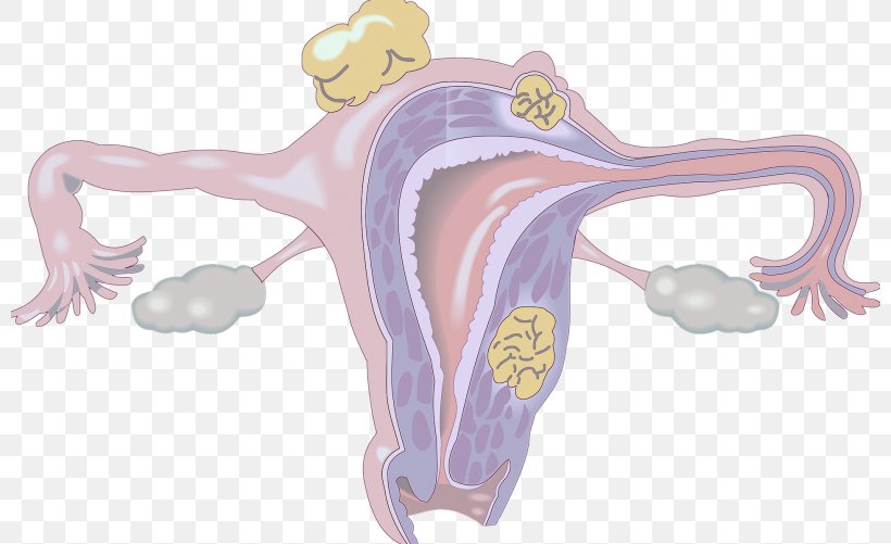 Uterine Fibroid Myoma Gynaecology Benignity Benign Tumor, PNG, 800x501px, Watercolor, Cartoon, Flower, Frame, Heart Download Free