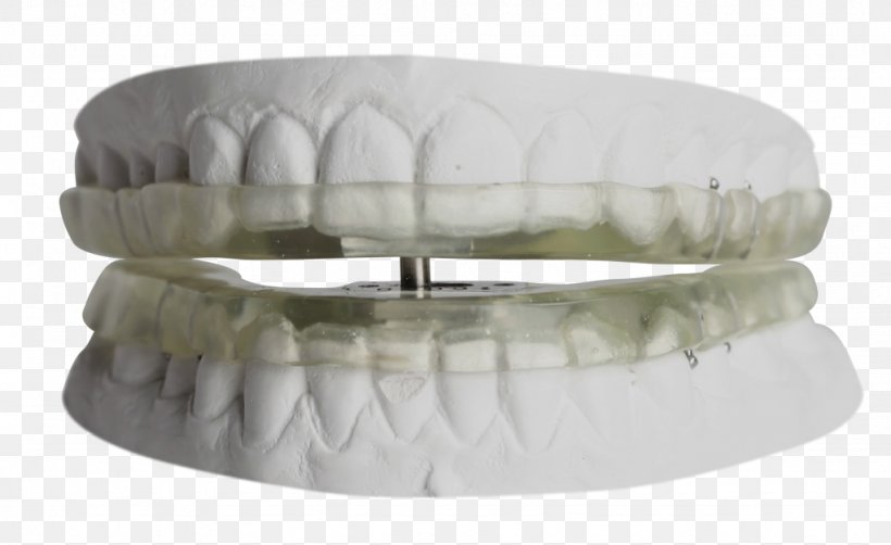 Temporomandibular Joint Dysfunction Orthodontics Dentistry Mouthguard, PNG, 1024x627px, Temporomandibular Joint Dysfunction, Dental Braces, Dentistry, Furniture, Jaw Download Free