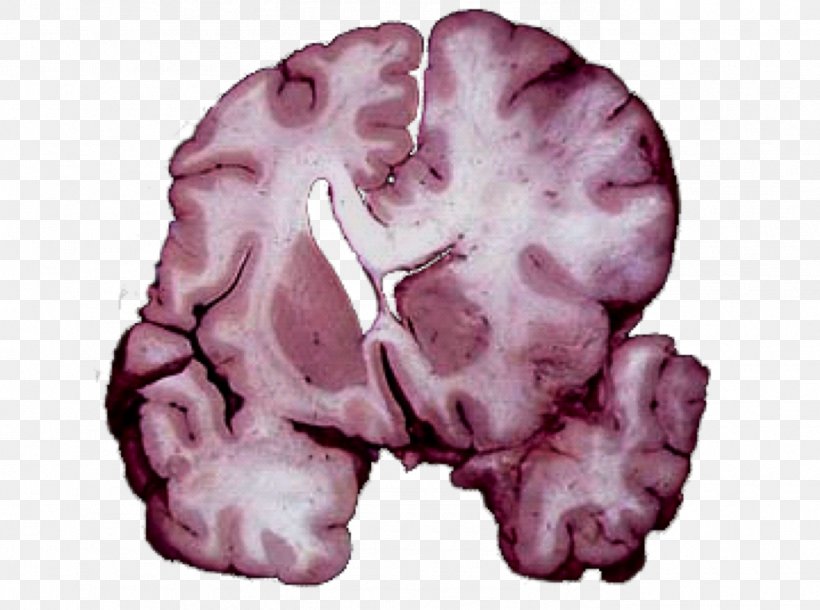 Brain Herniation Intracranial Pressure Traumatic Brain Injury Cerebellar Tonsil, PNG, 1388x1033px, Watercolor, Cartoon, Flower, Frame, Heart Download Free