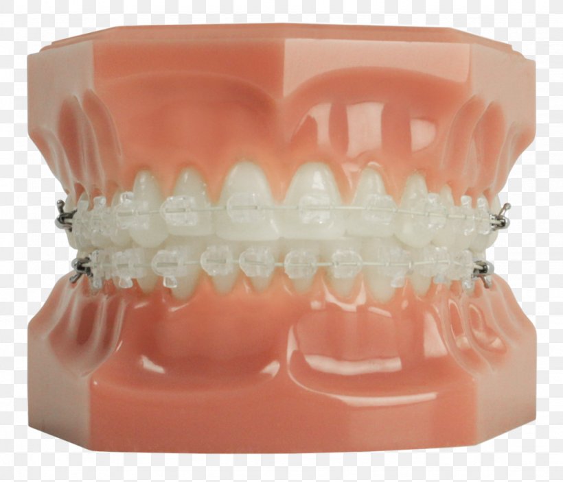 Tooth Dentistry Dental Braces Clear Aligners, PNG, 1024x878px, Tooth, Clear Aligners, Cosmetic Dentistry, Dental Braces, Dental Floss Download Free
