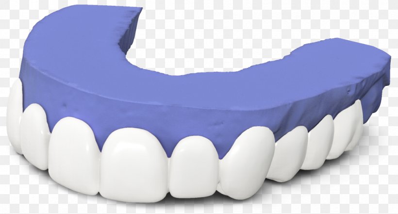Tooth Veneer Dentistry Dental Laboratory, PNG, 1036x558px, Tooth, Cadcam Dentistry, Dental Laboratory, Dentist, Dentistry Download Free