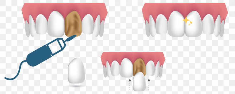 Cosmetic Dentistry Veneer Dental Composite Human Tooth, PNG, 1875x754px, Cosmetic Dentistry, Abrasion, Aesthetics, Coating, Cutlery Download Free