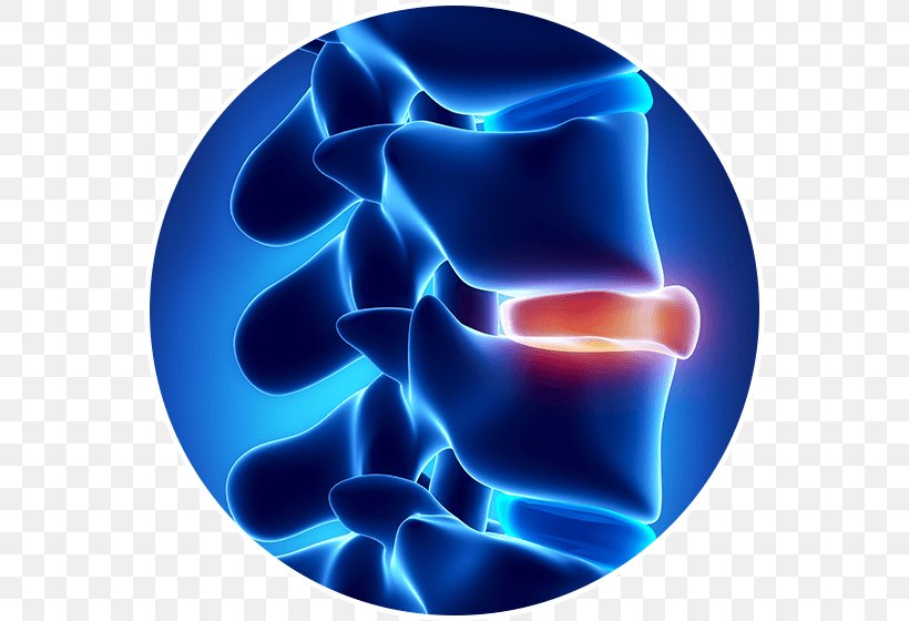 Spinal Disc Herniation Vertebral Column Intervertebral Disc Tratamento Back Pain, PNG, 560x560px, Spinal Disc Herniation, Back Pain, Disease, Electric Blue, Hernia Download Free