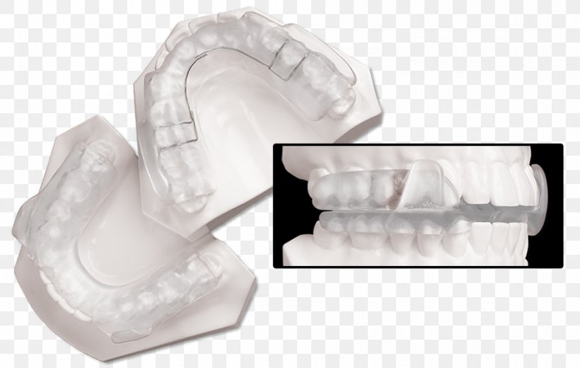 Splint Temporomandibular Joint Dysfunction Dentistry Jaw Orthopedic Surgery, PNG, 950x603px, Splint, Dentistry, Dorsal Fin, Home Appliance, Incisor Download Free