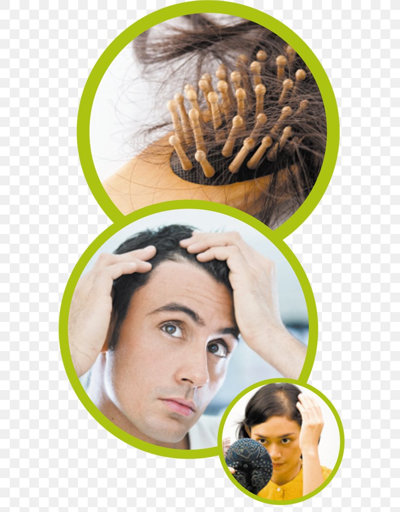 Management Of Hair Loss Hair Transplantation Human Hair Growth, PNG, 604x1050px, Hair Loss, Braid, Dihydrotestosterone, Forehead, Hair Download Free