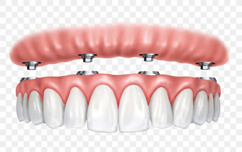 Dental Implant All-on-4 Dentistry Dentures, PNG, 2000x1263px, Dental Implant, Dental Arch, Dental Restoration, Dentist, Dentistry Download Free