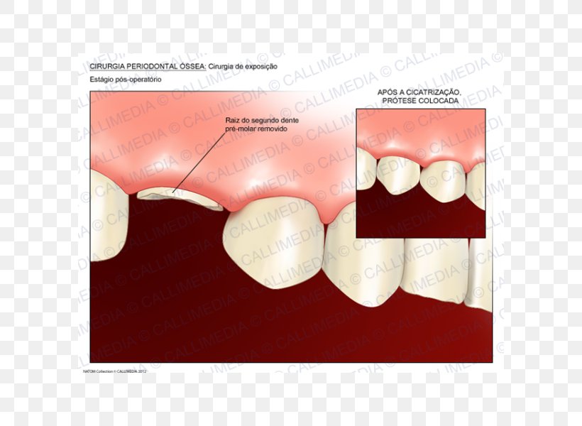 Tooth Crown Lengthening Dentistry Surgery, PNG, 600x600px, Tooth, Bone, Crown, Crown Lengthening, Dentin Download Free