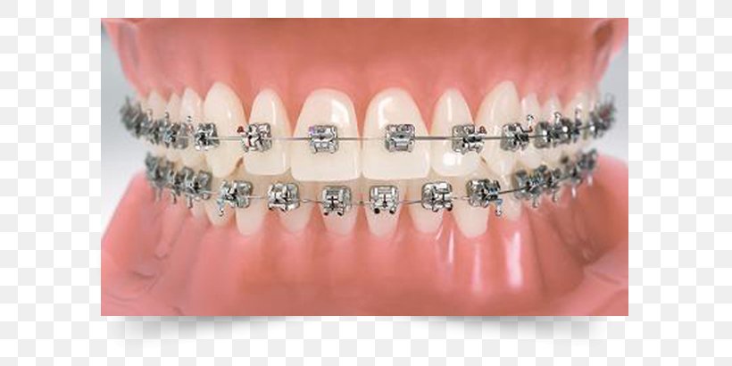 Orthodontics Dental Braces Dentistry Tooth, PNG, 654x410px, Orthodontics, Clear Aligners, Clinic, Cosmetic Dentistry, Crowding Of Teeth Download Free