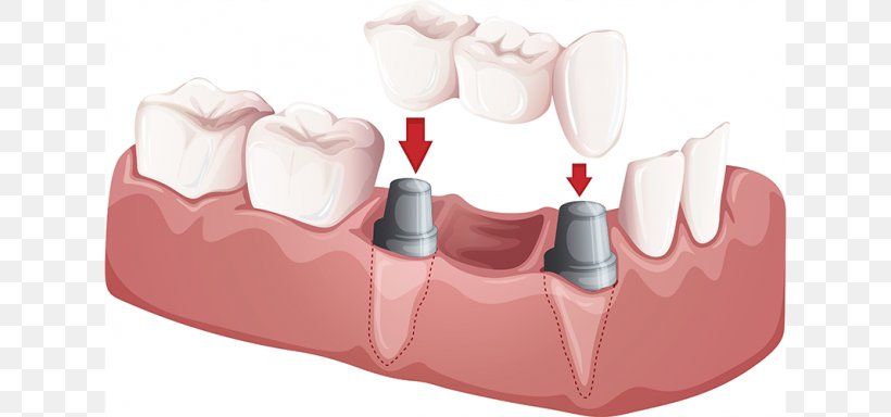 Bridge Dentistry Crown Dental Implant, PNG, 768x384px, Watercolor, Cartoon, Flower, Frame, Heart Download Free