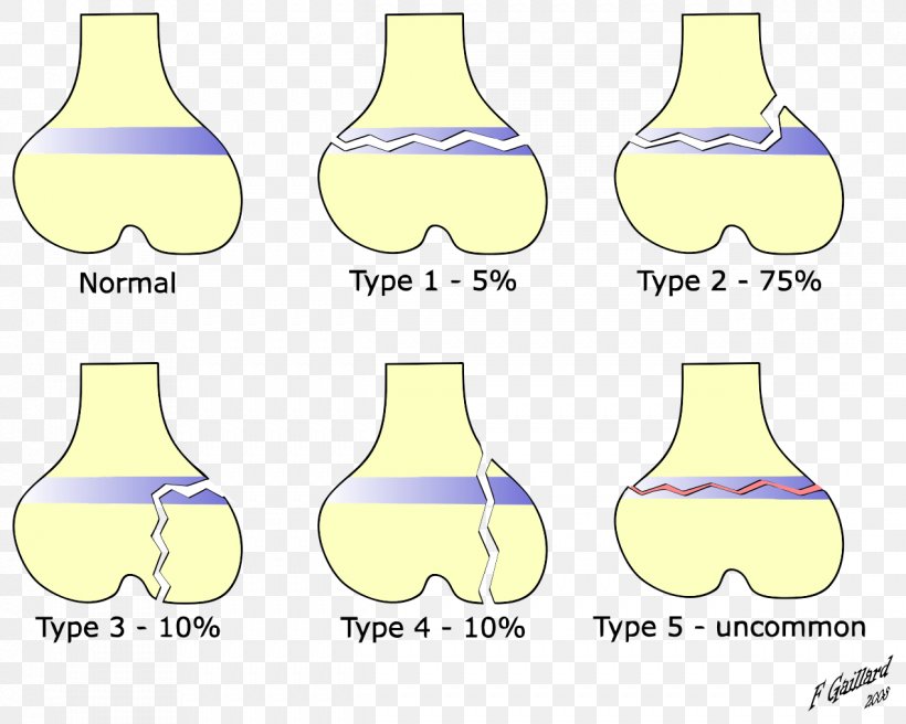 Salter–Harris Fracture Bone Fracture Epiphyseal Plate Ankle Fracture Metaphysis, PNG, 1271x1018px, Bone Fracture, Ankle Fracture, Area, Distal Radius Fracture, Epiphyseal Plate Download Free