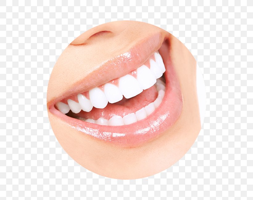Tooth Whitening Human Tooth Dentistry Veneer, PNG, 650x650px, Tooth Whitening, Cheek, Chin, Color, Cosmetic Dentistry Download Free