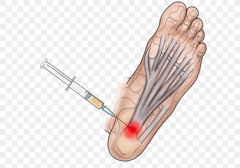 Thumb Plantar Fasciitis Platelet-rich Plasma Therapy Ankle, PNG, 930x651px, Watercolor, Cartoon, Flower, Frame, Heart Download Free