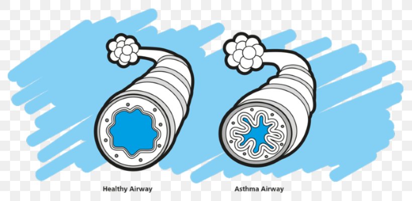 Asthma Spacer Montelukast Nursing Care Clip Art, PNG, 799x400px, Asthma, Acute Severe Asthma, Allergy, Asthma Spacer, Cough Download Free