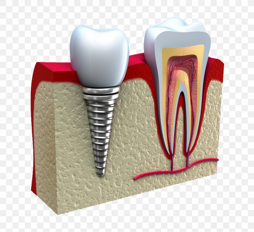 Dental Implant Dentistry Dental Restoration, PNG, 1000x916px, Watercolor, Cartoon, Flower, Frame, Heart Download Free