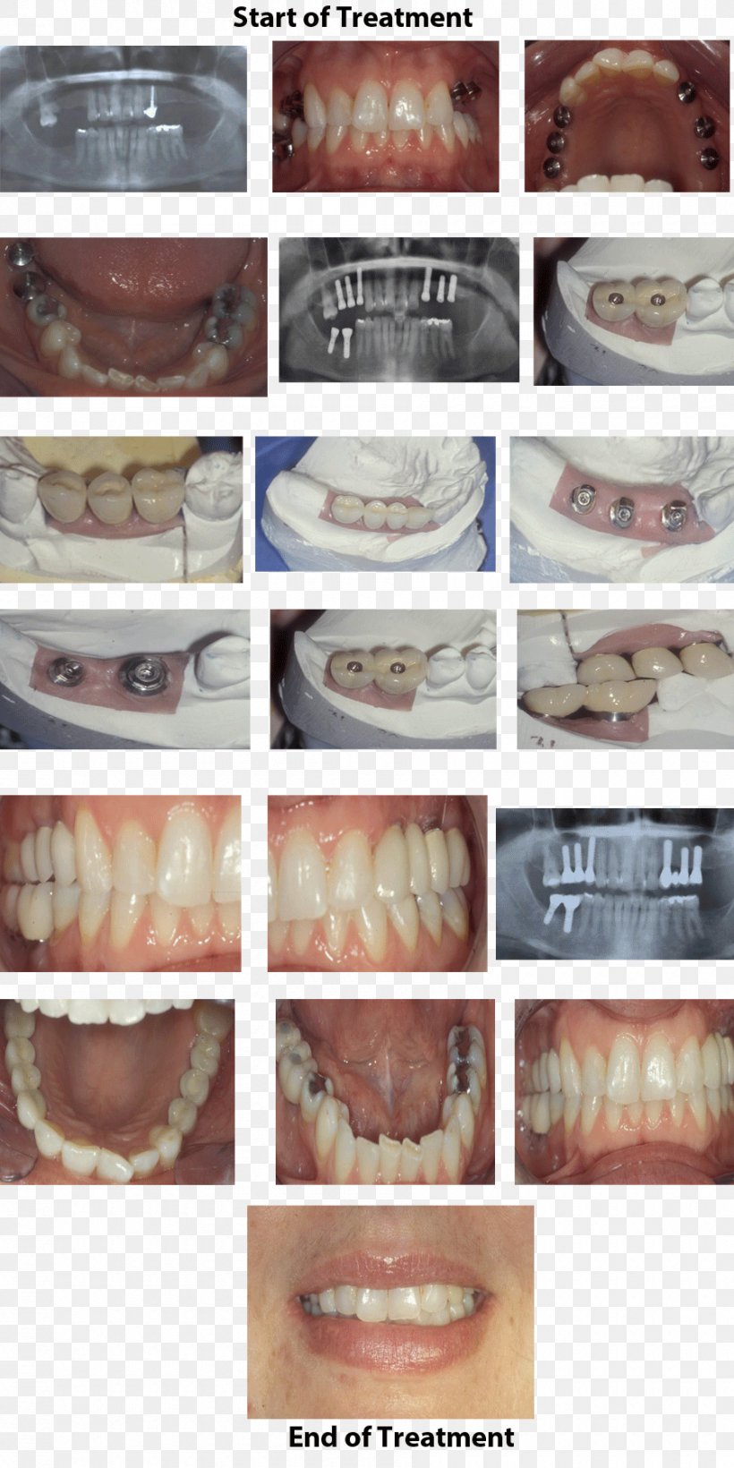 Kapshtica Renis DDS Dental Implant Tooth Dentistry, PNG, 900x1800px, Kapshtica Renis Dds, Abutment, Baking, Bridge, Ceramic Download Free