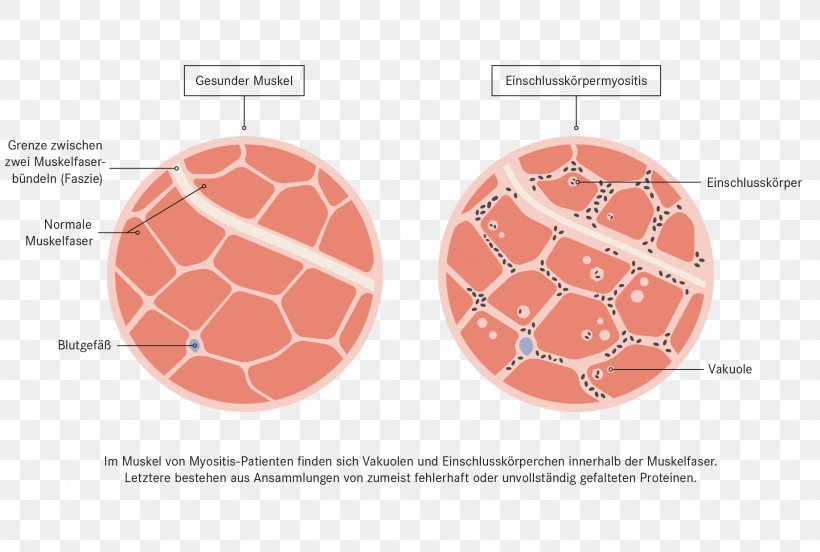 Inclusion Body Myositis Therapy Myopathy Disease, PNG, 1840x1240px, Therapy, Amyotrophic Lateral Sclerosis, Arthritis, Disease, Inflammation Download Free