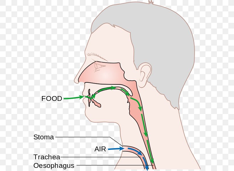 Laryngectomy Voice Prosthesis Larynx Nose, PNG, 586x600px, Watercolor, Cartoon, Flower, Frame, Heart Download Free