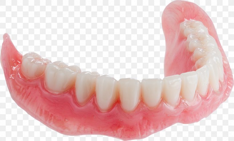 Tooth Dentures Mandible Dental Arch Paper Mill Dental, PNG, 1000x603px, Tooth, Dental Arch, Dental Implant, Dentist, Dentistry Download Free