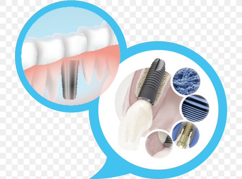 Dental Implant Dentistry OSSTEM IMPLANT, PNG, 720x609px, Dental Implant, Brush, Dental Extraction, Dental Surgery, Dentist Download Free