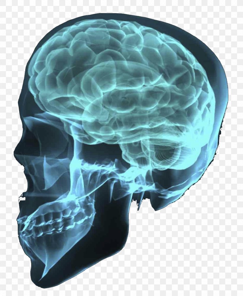 Traumatic Brain Injury Human Brain Brain Tumor, PNG, 943x1149px, Brain, Bone, Brain Injury, Brain Tumor, Cancer Download Free
