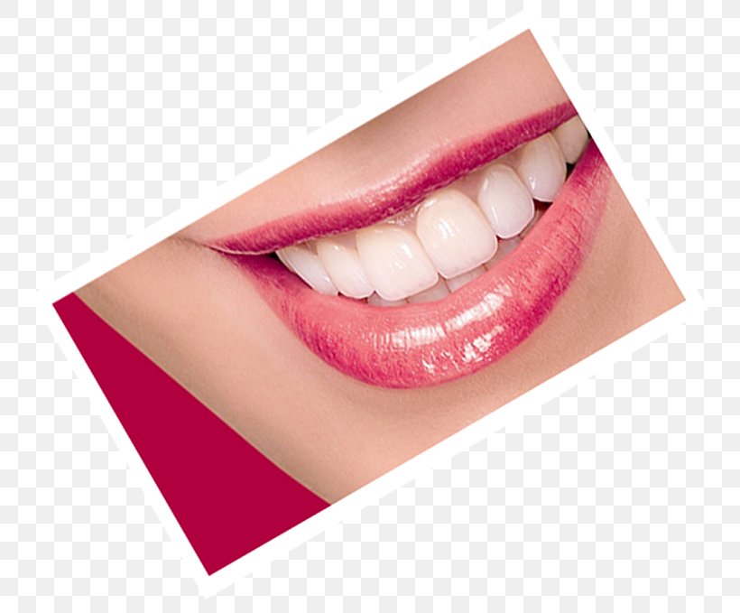 Tooth Dentistry Dental Prosthesis American Dental Association, PNG, 772x679px, Tooth, American Dental Association, Artistry, Blog, Cosmetic Dentistry Download Free