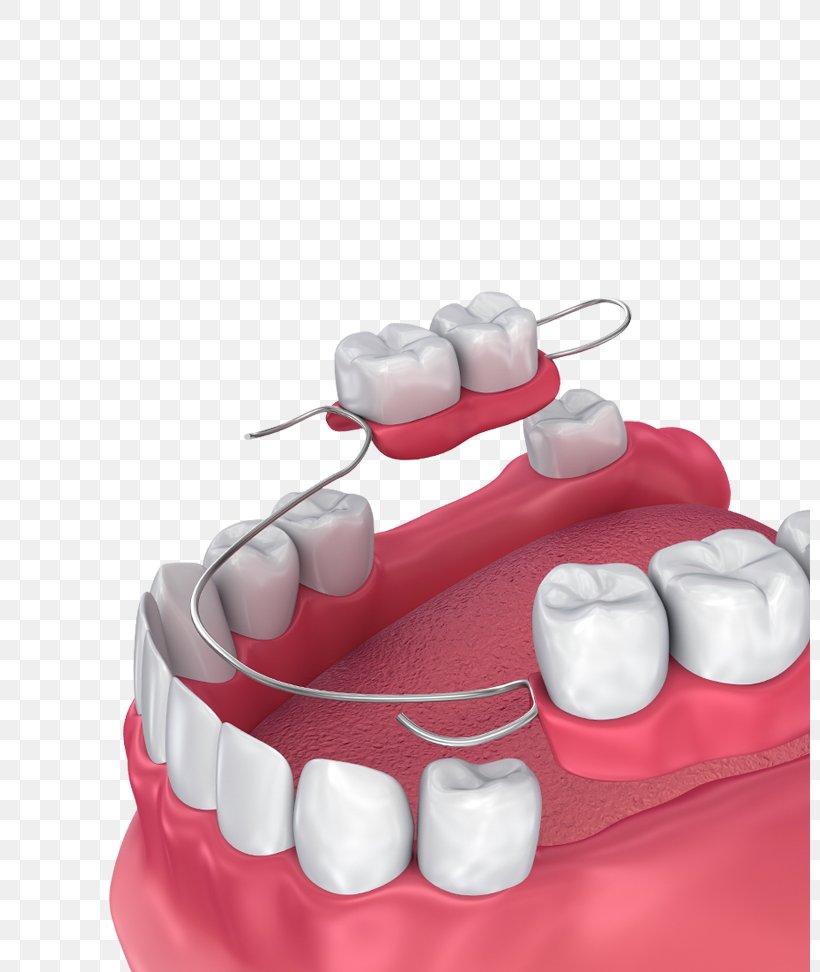 Removable Partial Denture Dentures Dentistry Bridge Tooth, PNG, 800x972px, Removable Partial Denture, Amalgam, Apicoectomy, Bridge, Dental Implant Download Free