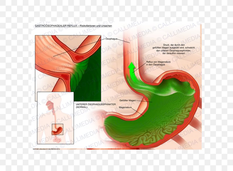 Gastroesophageal Reflux Disease Gastroenterology Gastroenteritis Pathology, PNG, 600x600px, Gastroesophageal Reflux Disease, Gastroenteritis, Gastroenterology, Homo Sapiens, Pathology Download Free