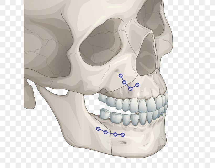 Jaw Orthognathic Surgery Chin Plastic Surgery, PNG, 640x640px, Jaw, Alaleuanluu, Bone, Chin, Face Download Free