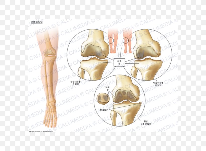 Knee Arthritis Osteoarthritis Pain, PNG, 600x600px, Watercolor, Cartoon, Flower, Frame, Heart Download Free
