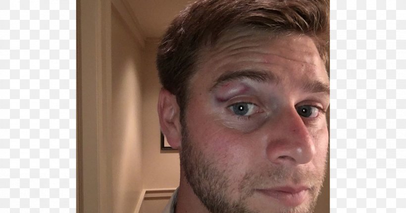 Ryan Harrison Tennis Player Marriage Beurre Noir, PNG, 1200x630px, 2017, Tennis Player, Beard, Black Eye, Cheek Download Free