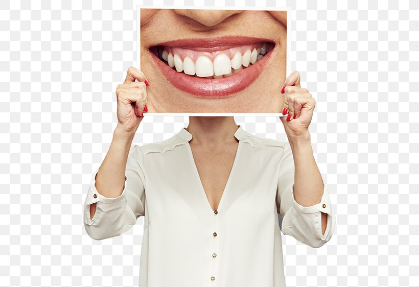 Cosmetic Dentistry Veneer Dental Implant, PNG, 500x562px, Dentistry, Chin, Cosmetic Dentistry, Crown, Dental Implant Download Free