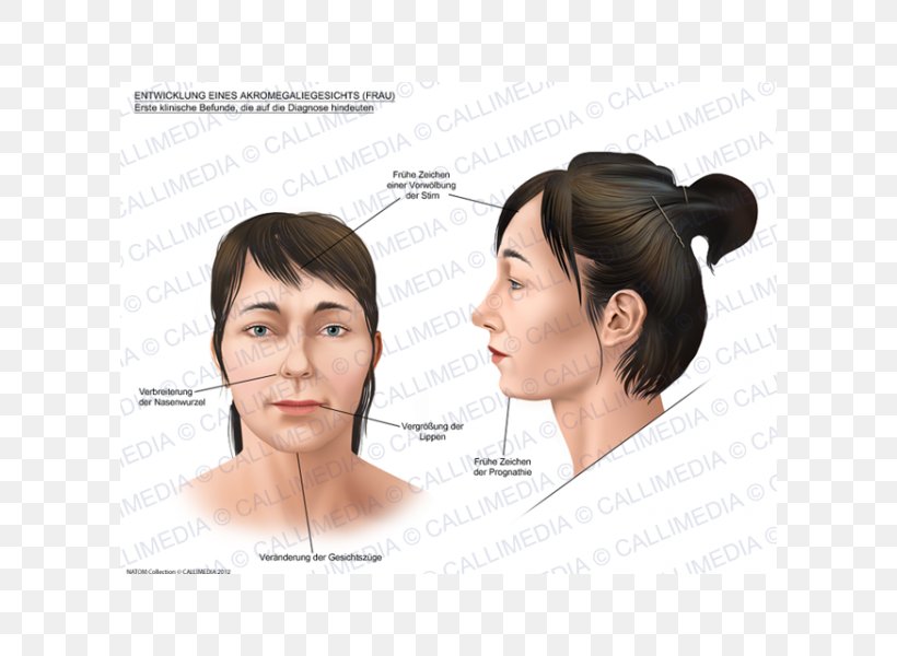 Acromegaly Face Skull Bossing Gigantism Symptom, PNG, 600x600px, Acromegaly, Cheek, Chin, Ear, Endocrinology Download Free
