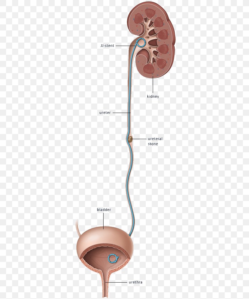 Ureteric Stent Stenting Excretory System Kidney, PNG, 345x982px, Watercolor, Cartoon, Flower, Frame, Heart Download Free