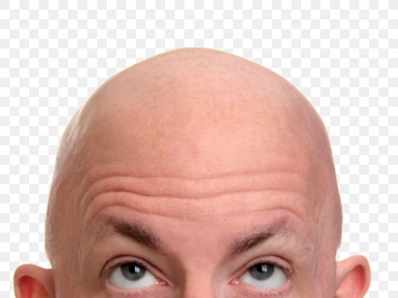 Hair Loss Stem Cell Hair Transplantation Hair Follicle Hairstyle, PNG, 2048x1536px, Hair Loss, Cheek, Chin, Close Up, Drug Download Free