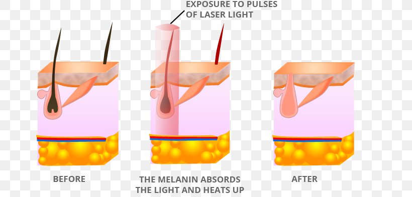 Laser Hair Removal Fotoepilazione Intense Pulsed Light, PNG, 778x393px, Laser Hair Removal, Artificial Hair Integrations, Beauty Parlour, Drink, Fotoepilazione Download Free