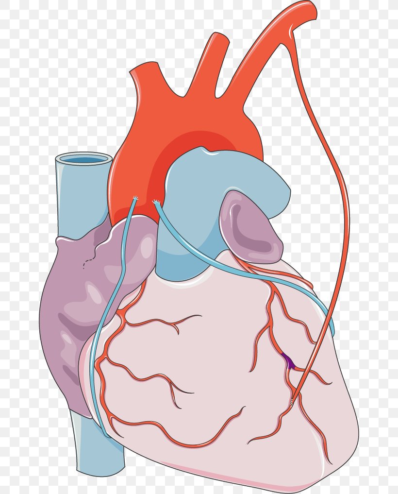 Myocardial Infarction Heart Monocyte Coronary Artery Disease Medical Clip Art, PNG, 660x1017px, Watercolor, Cartoon, Flower, Frame, Heart Download Free