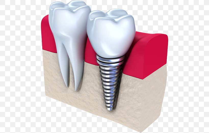 Dental Implant Dentistry Tooth, PNG, 500x523px, Watercolor, Cartoon, Flower, Frame, Heart Download Free