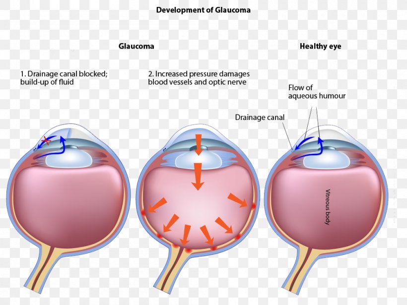 Glaucoma Laser Surgery Eye Disease Ophthalmology, PNG, 1000x750px, Watercolor, Cartoon, Flower, Frame, Heart Download Free