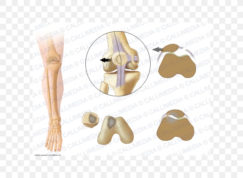 Shoulder Patella Bone Subluxation Joint Dislocation, PNG, 600x600px, Watercolor, Cartoon, Flower, Frame, Heart Download Free