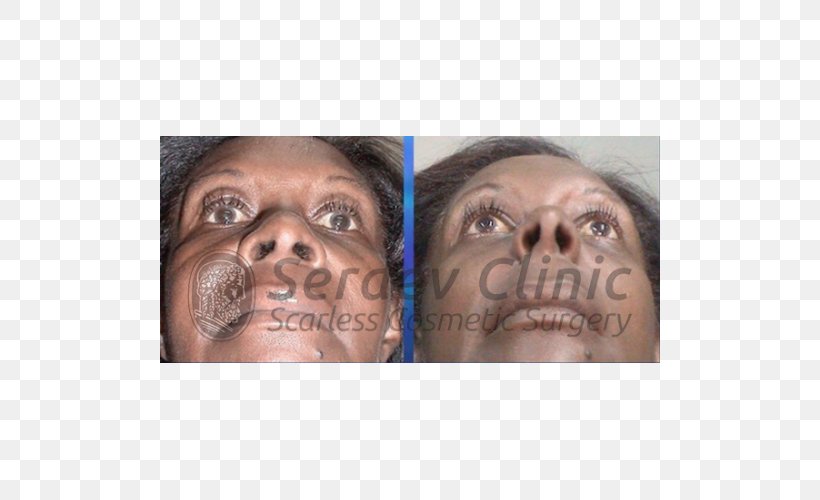 Snout Serdev Suture Surgical Suture Nose Cheek, PNG, 500x500px, Snout, Cheek, Chin, Ear, Eye Download Free