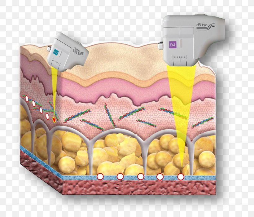 Rhytidectomy High-intensity Focused Ultrasound Skin Liposuction, PNG, 764x700px, Rhytidectomy, Commodity, Dermatology, Exfoliation, Face Download Free