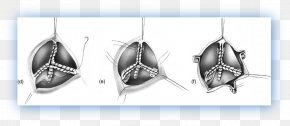Percutaneous Aortic Valve Replacement - Aortic Valve Left Coronary Artery Coronary Arteries Aorta PNG