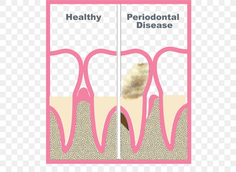 Periodontology Periodontal Disease Periodontium Gums Tooth, PNG, 727x600px, Watercolor, Cartoon, Flower, Frame, Heart Download Free