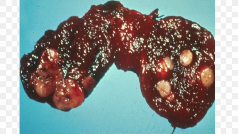 Thyroid Cancer Gland Thyroid Nodule, PNG, 960x540px, Thyroid Cancer, Breast Cancer, Cancer, Disease, Endocrinology Download Free