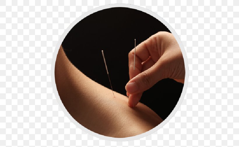 Acupuncture Therapy Traditional Chinese Medicine Health, PNG, 600x504px, Acupuncture, Ache, Akupunktiopiste, Akupunkturforeningen, Back Pain Download Free